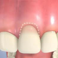 Gingival Crown Lengthening