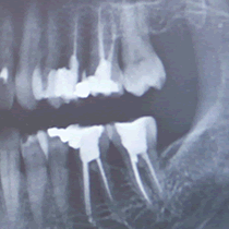 Cavity Detecting X-Rays