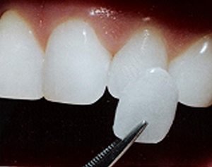 Porcelain Veneers/No Prep Veneers